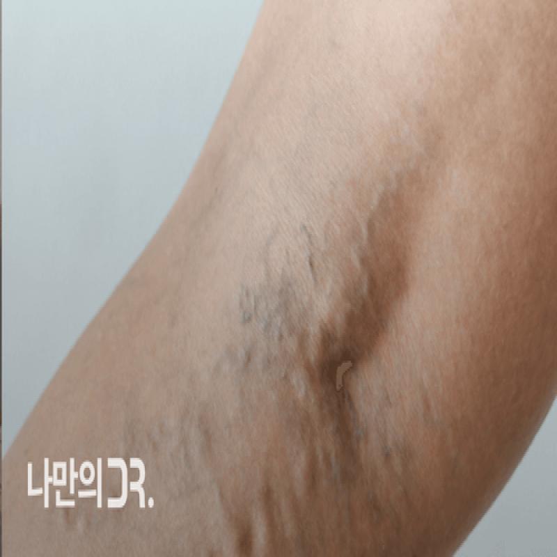 다리를 떠는 것은 하지정맥류와 같은 혈관 질환에 부정적인 영향을 미친다.